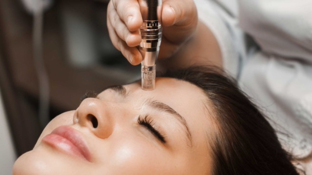 Microneedling Newcastle